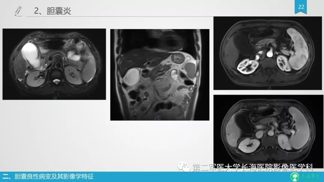 影像PPT - 【PPT】胆囊良性病变及其影像学特征-21