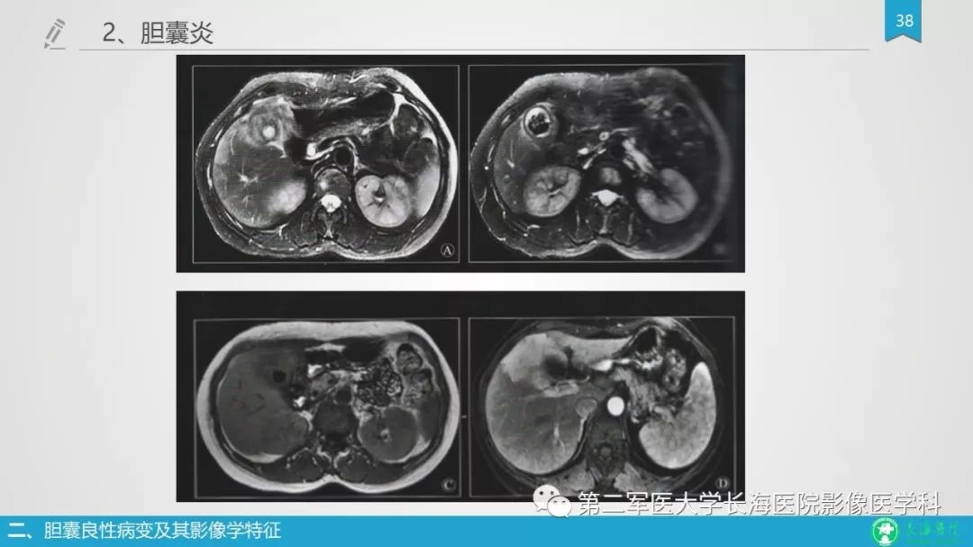影像PPT - 【PPT】胆囊良性病变及其影像学特征-37