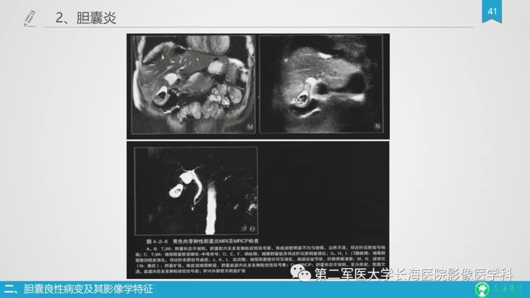 影像PPT - 【PPT】胆囊良性病变及其影像学特征-40