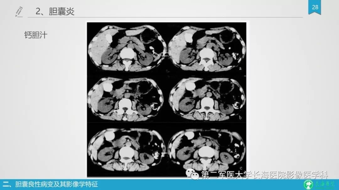 影像PPT - 【PPT】胆囊良性病变及其影像学特征-27