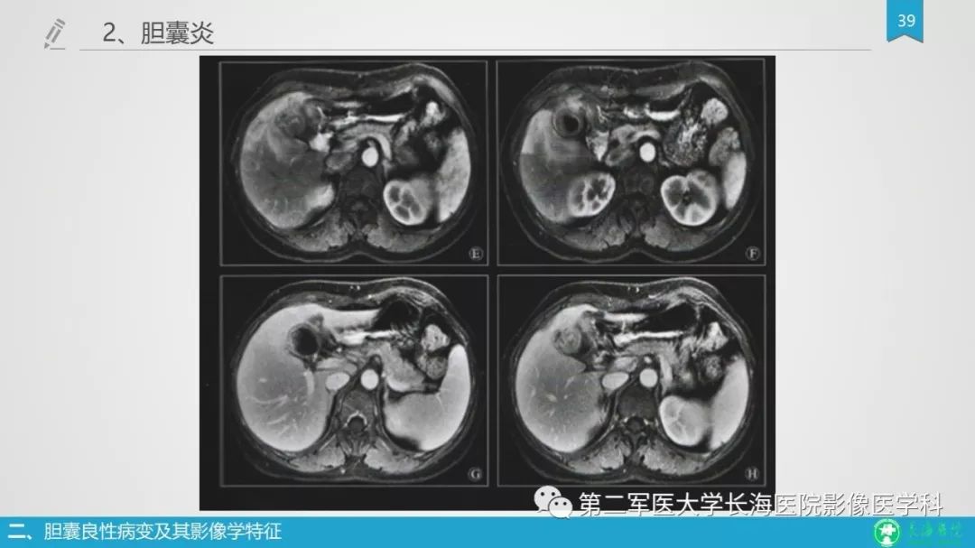影像PPT - 【PPT】胆囊良性病变及其影像学特征-38