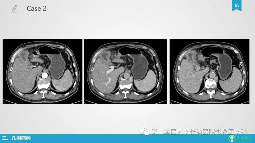 影像PPT - 【PPT】胆囊良性病变及其影像学特征-64