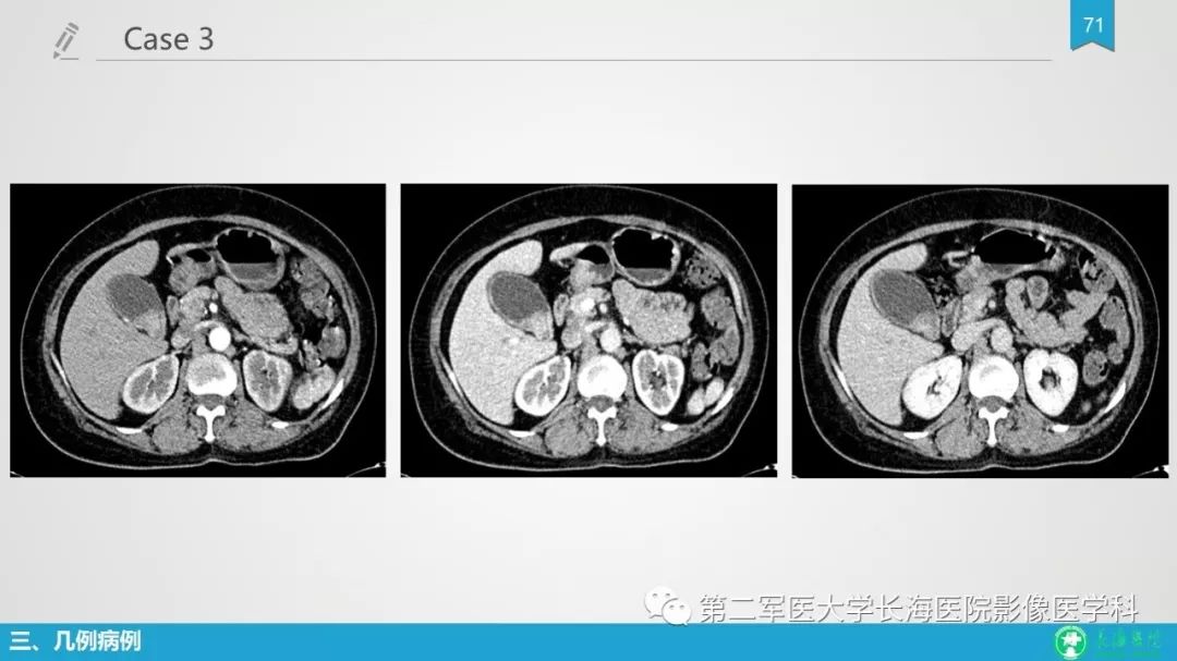 影像PPT - 【PPT】胆囊良性病变及其影像学特征-70