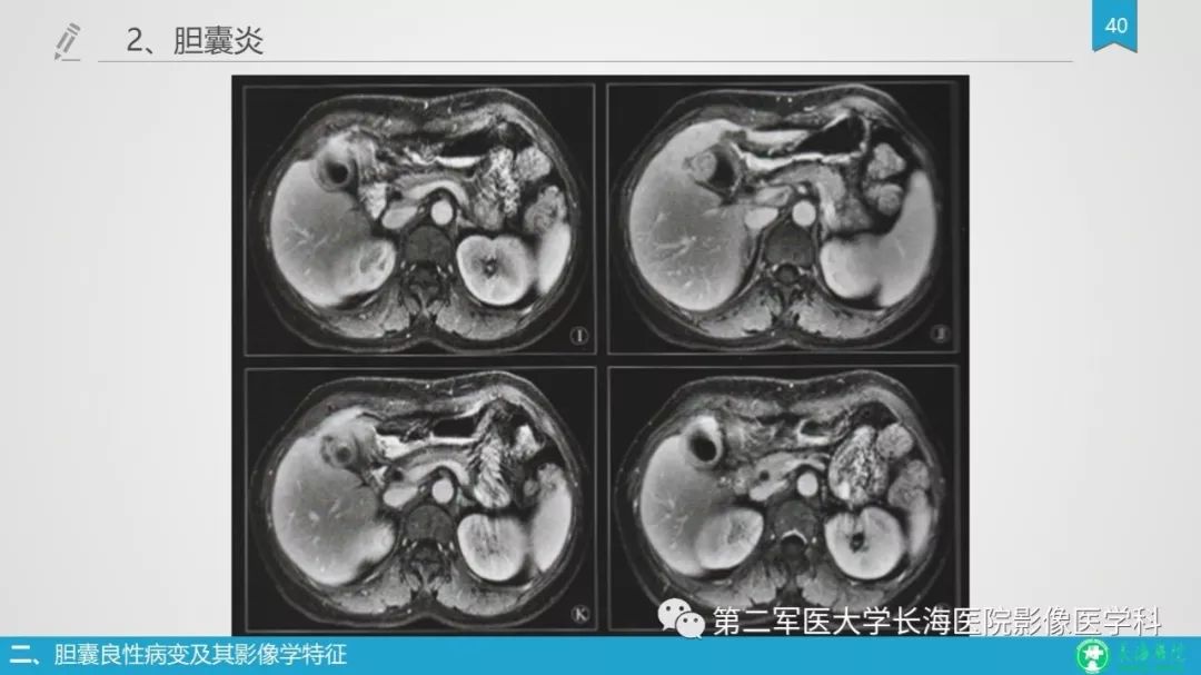 影像PPT - 【PPT】胆囊良性病变及其影像学特征-39