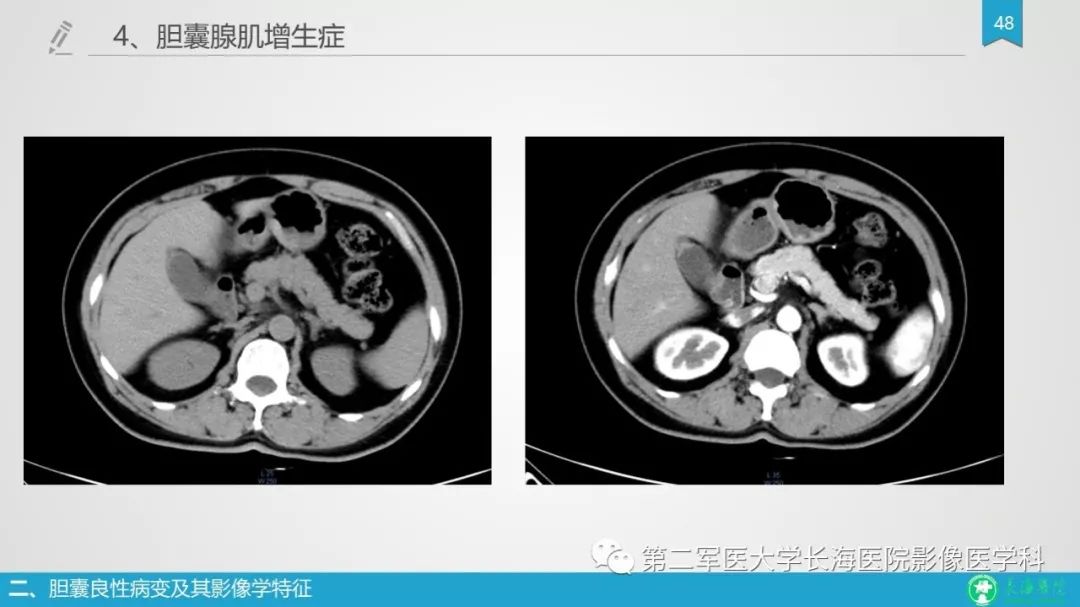 影像PPT - 【PPT】胆囊良性病变及其影像学特征-47