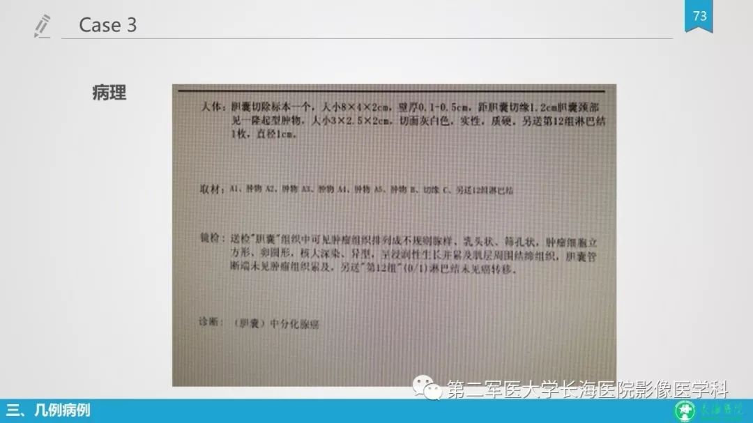 影像PPT - 【PPT】胆囊良性病变及其影像学特征-72
