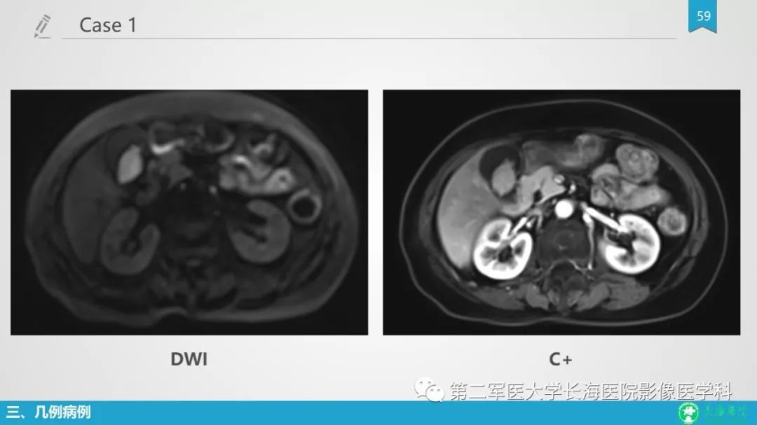 影像PPT - 【PPT】胆囊良性病变及其影像学特征-58