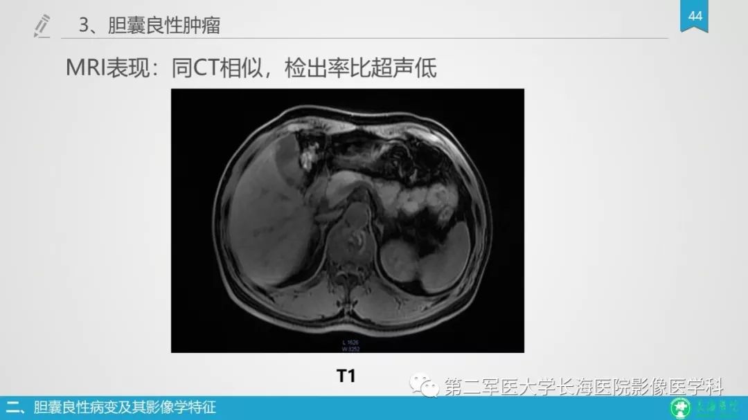 影像PPT - 【PPT】胆囊良性病变及其影像学特征-43