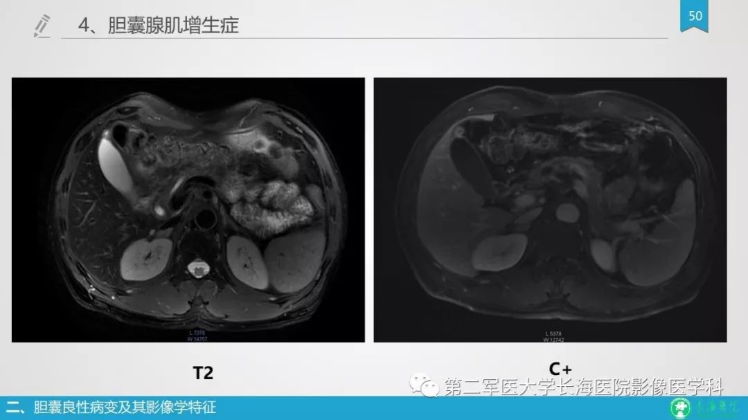 影像PPT - 【PPT】胆囊良性病变及其影像学特征-49