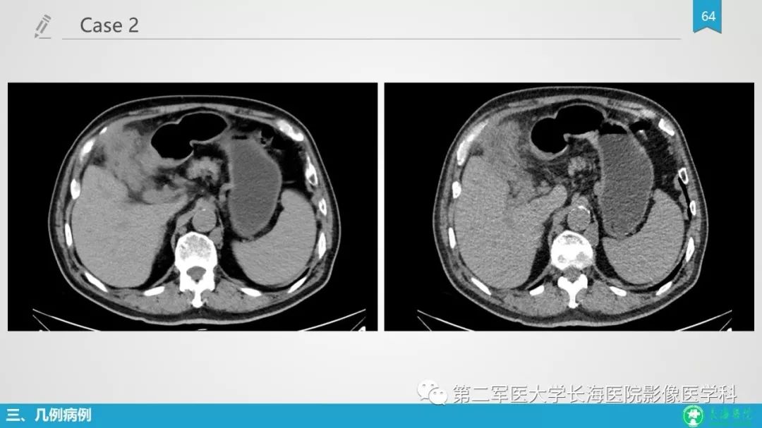 影像PPT - 【PPT】胆囊良性病变及其影像学特征-63