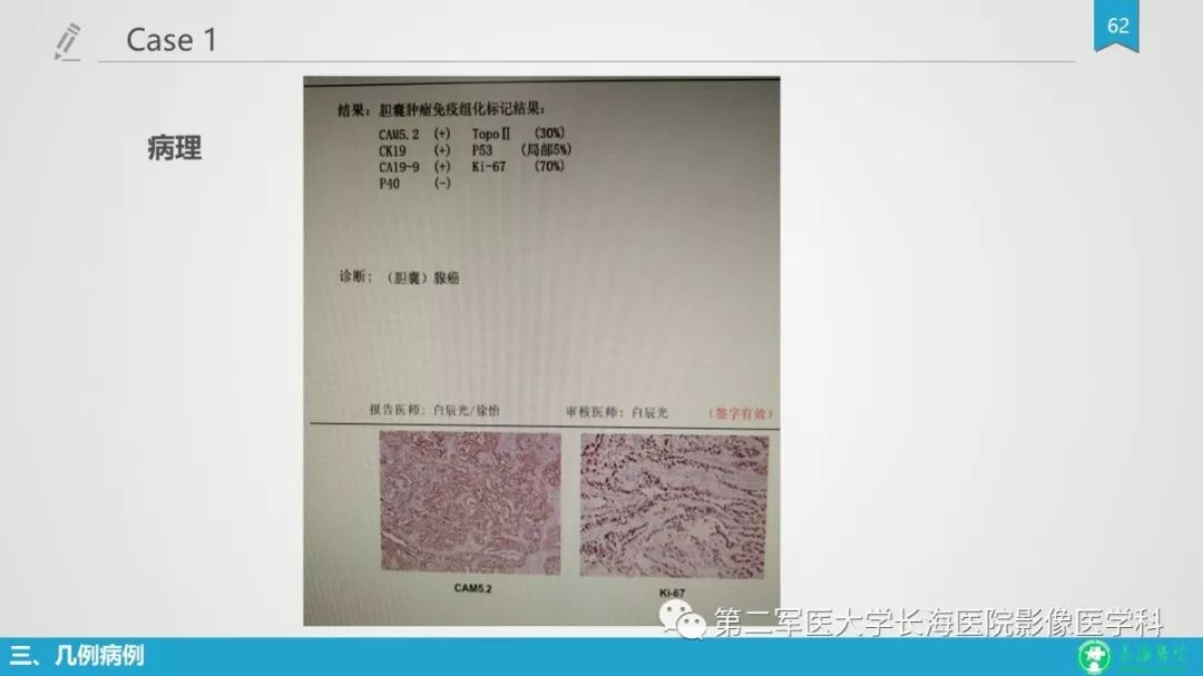 影像PPT - 【PPT】胆囊良性病变及其影像学特征-61