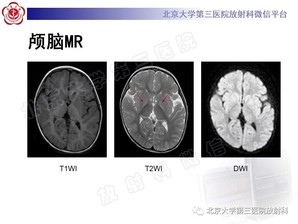 影像PPT - 【PPT】胆红素脑病-3
