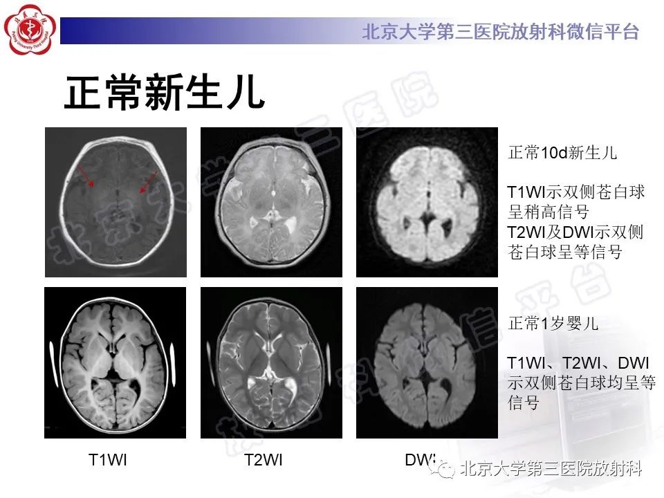 影像PPT - 【PPT】胆红素脑病-15