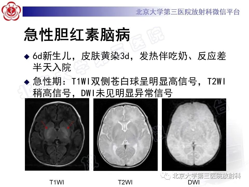 影像PPT - 【PPT】胆红素脑病-16