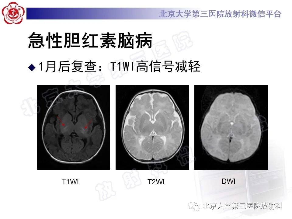 影像PPT - 【PPT】胆红素脑病-17