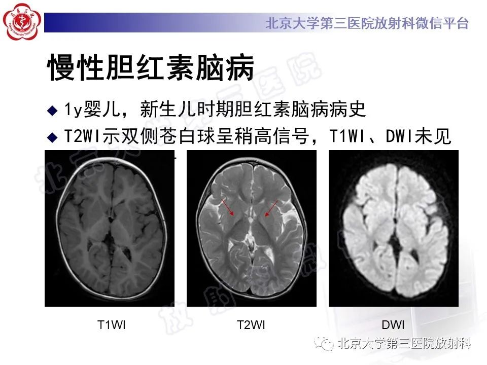 影像PPT - 【PPT】胆红素脑病-18