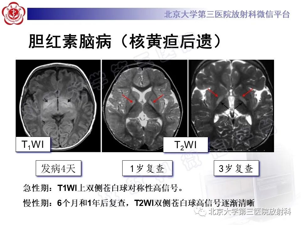 影像PPT - 【PPT】胆红素脑病-19