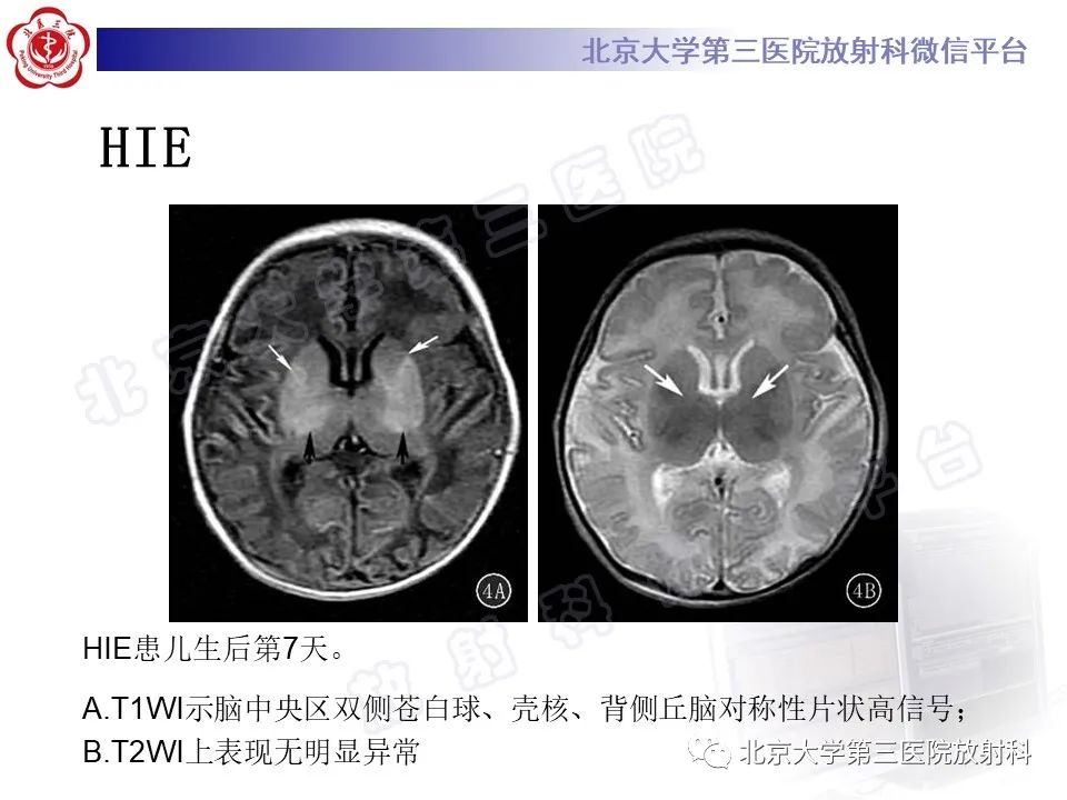 影像PPT - 【PPT】胆红素脑病-25