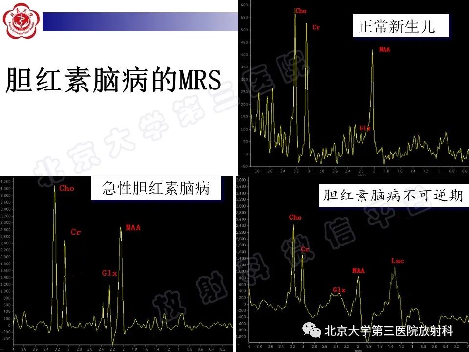影像PPT - 【PPT】胆红素脑病-21
