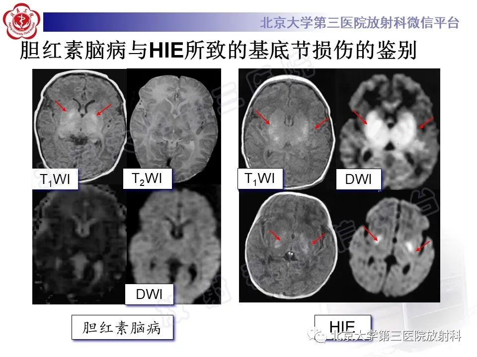 影像PPT - 【PPT】胆红素脑病-27