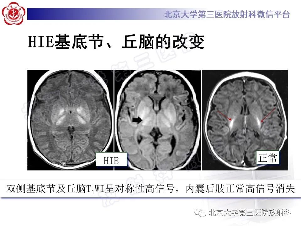 影像PPT - 【PPT】胆红素脑病-26