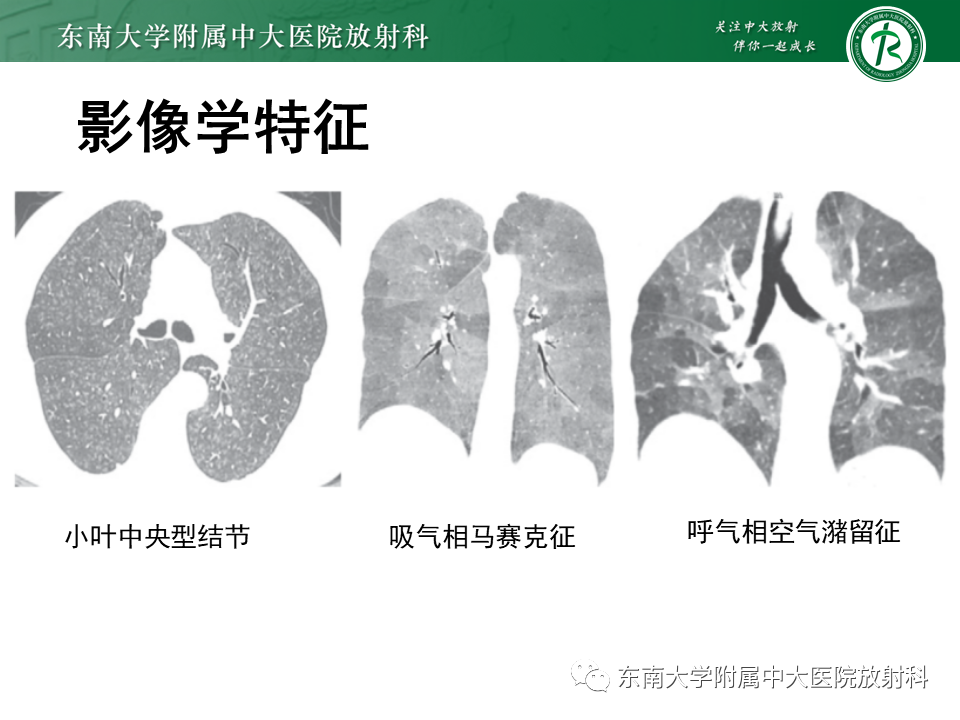 影像PPT - 【PPT】过敏性肺炎-11 影像PPT - 【PPT】过敏性肺炎-11