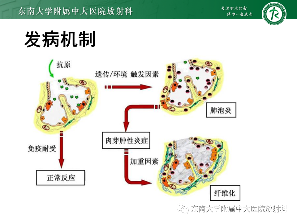 影像PPT - 【PPT】过敏性肺炎-6 影像PPT - 【PPT】过敏性肺炎-6