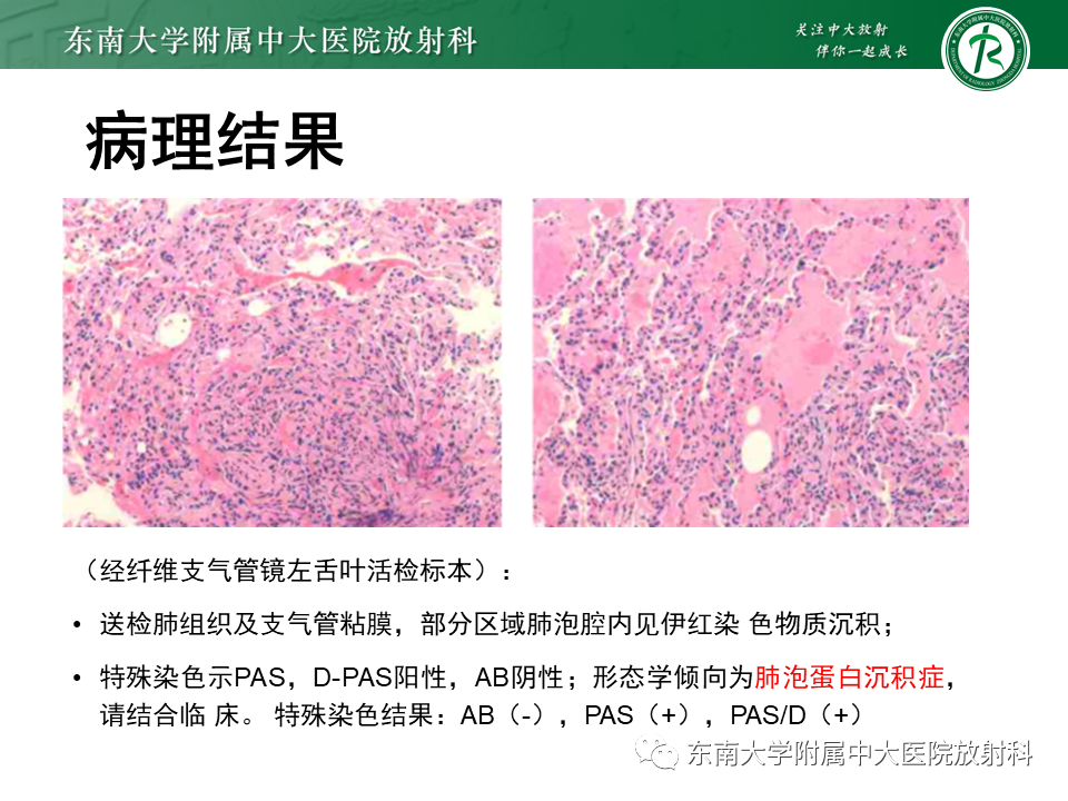 影像PPT - 【PPT】过敏性肺炎-29 影像PPT - 【PPT】过敏性肺炎-29