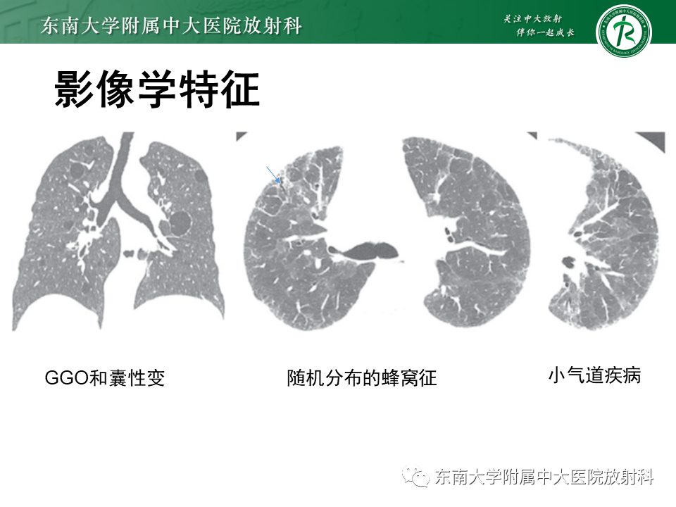 影像PPT - 【PPT】过敏性肺炎-12 影像PPT - 【PPT】过敏性肺炎-12