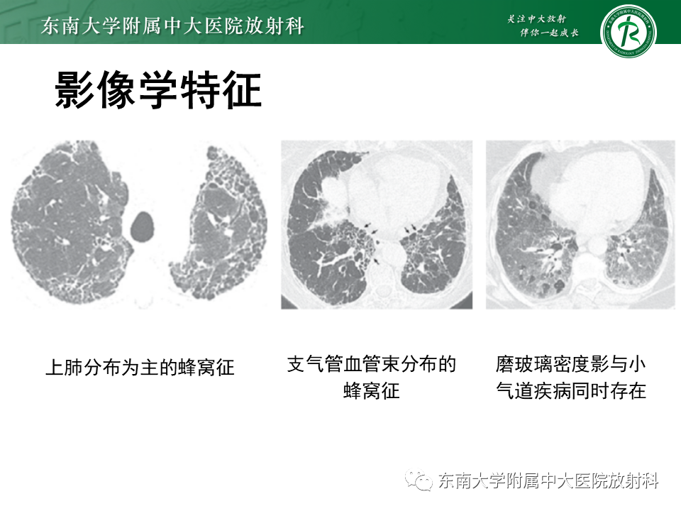 影像PPT - 【PPT】过敏性肺炎-13 影像PPT - 【PPT】过敏性肺炎-13