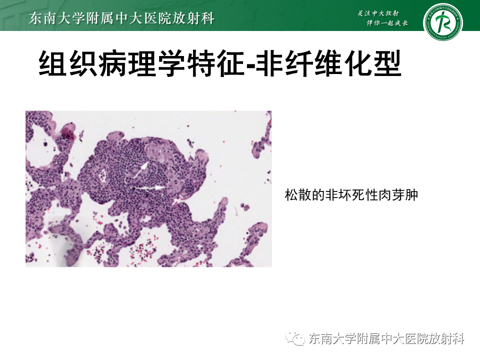 影像PPT - 【PPT】过敏性肺炎-18 影像PPT - 【PPT】过敏性肺炎-18