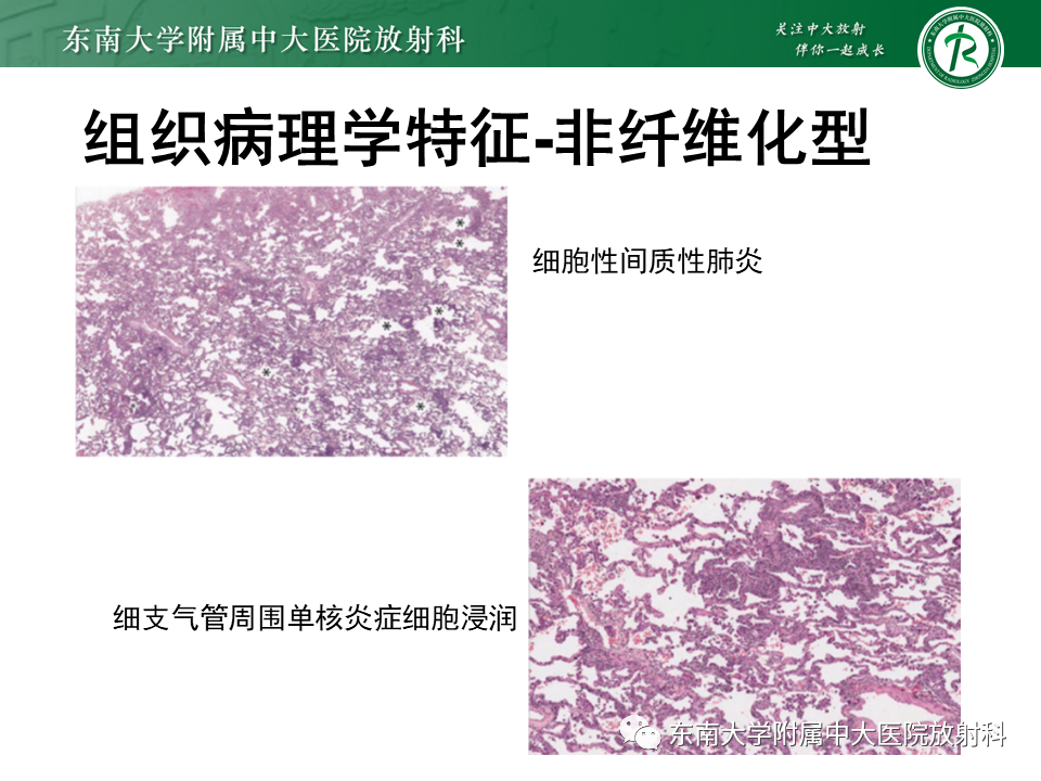 影像PPT - 【PPT】过敏性肺炎-16 影像PPT - 【PPT】过敏性肺炎-16