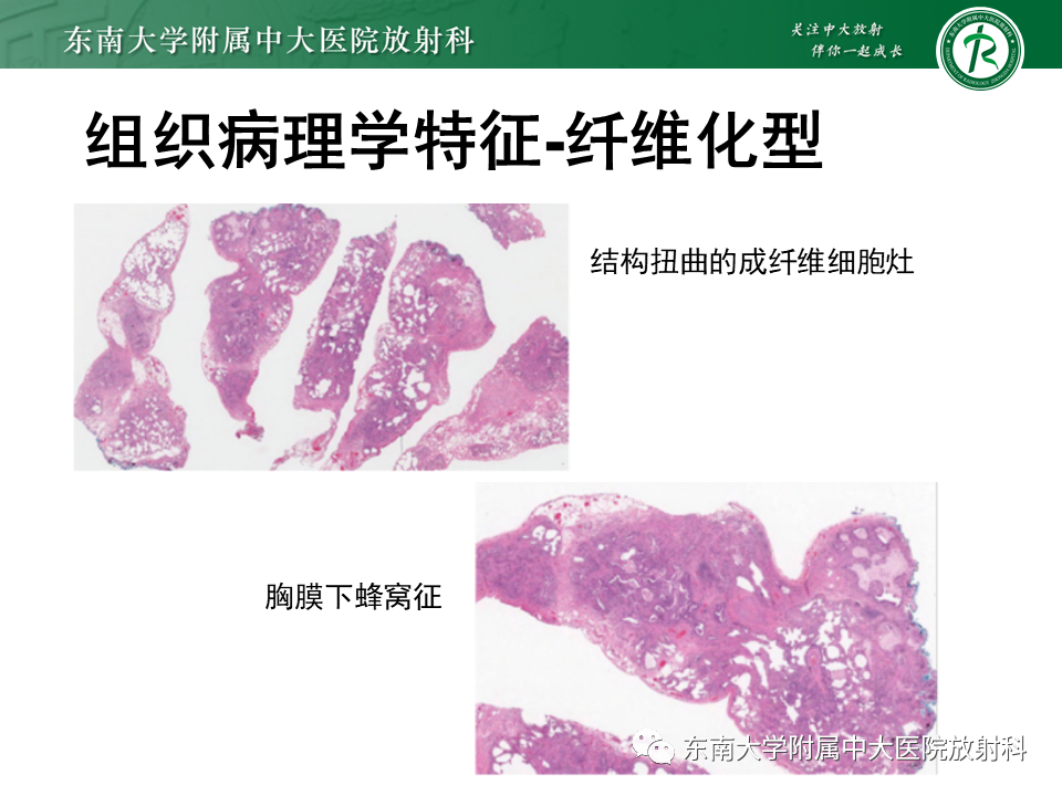 影像PPT - 【PPT】过敏性肺炎-21 影像PPT - 【PPT】过敏性肺炎-21