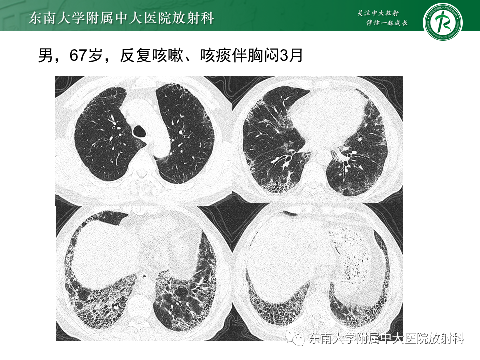 影像PPT - 【PPT】过敏性肺炎-31 影像PPT - 【PPT】过敏性肺炎-31