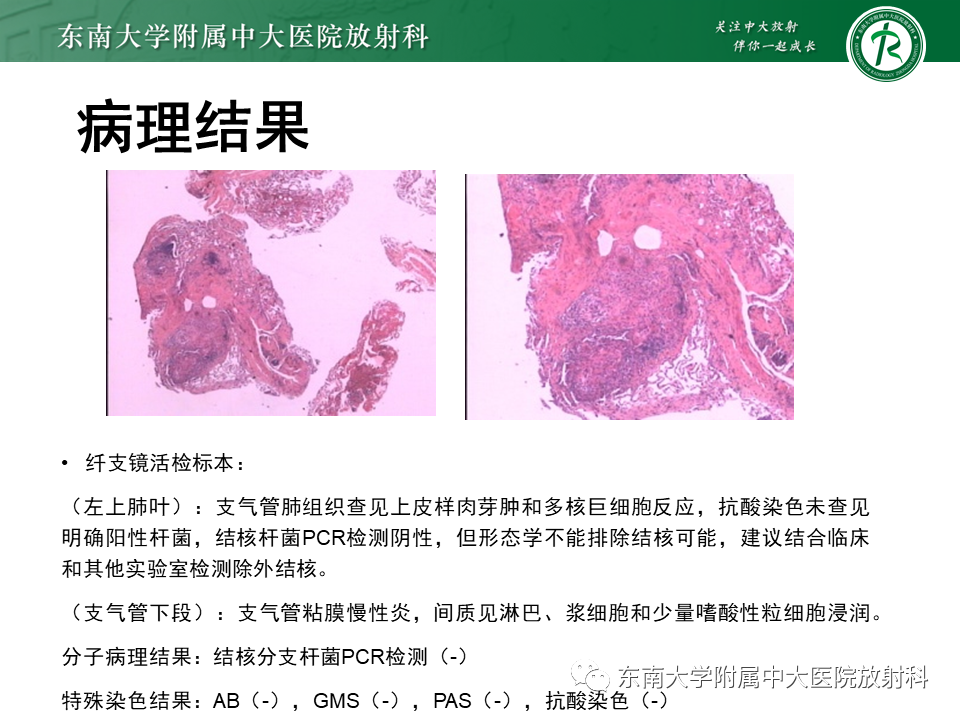 影像PPT - 【PPT】过敏性肺炎-35 影像PPT - 【PPT】过敏性肺炎-35