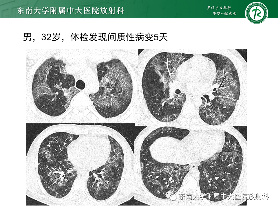 影像PPT - 【PPT】过敏性肺炎-28 影像PPT - 【PPT】过敏性肺炎-28
