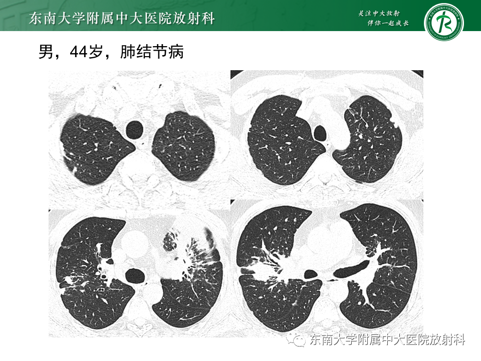 影像PPT - 【PPT】过敏性肺炎-34 影像PPT - 【PPT】过敏性肺炎-34