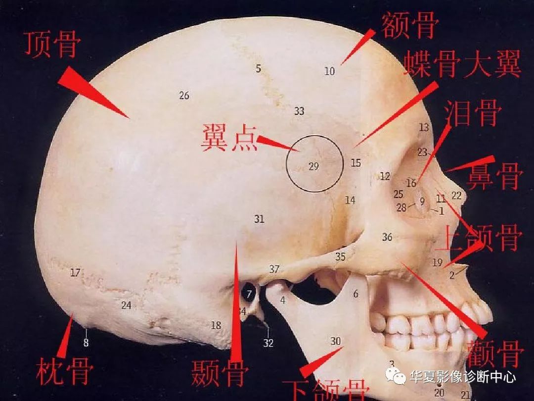 影像PPT - 【PPT】颅骨外伤性骨折CT诊断-7