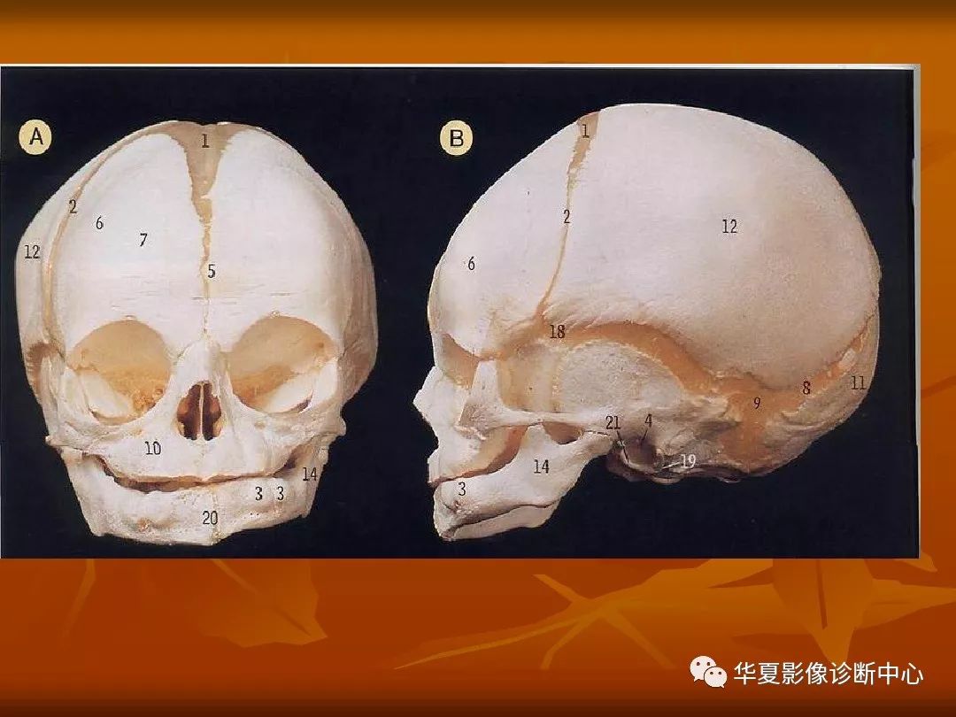 影像PPT - 【PPT】颅骨外伤性骨折CT诊断-9