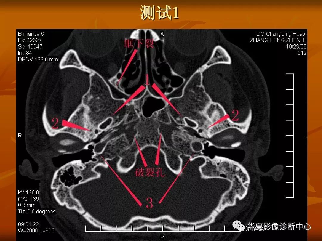 影像PPT - 【PPT】颅骨外伤性骨折CT诊断-2