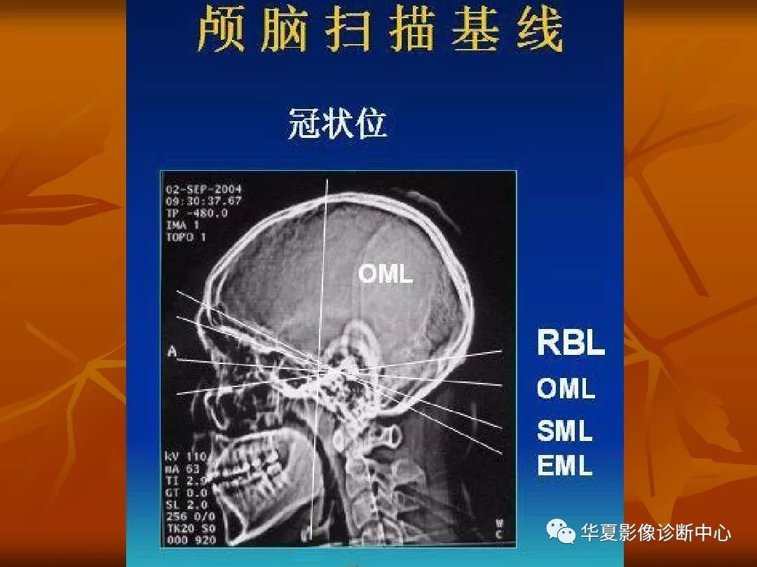 影像PPT - 【PPT】颅骨外伤性骨折CT诊断-12