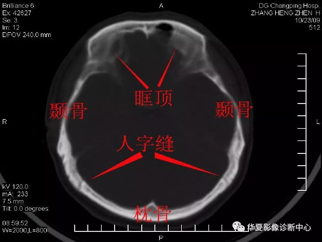 影像PPT - 【PPT】颅骨外伤性骨折CT诊断-18