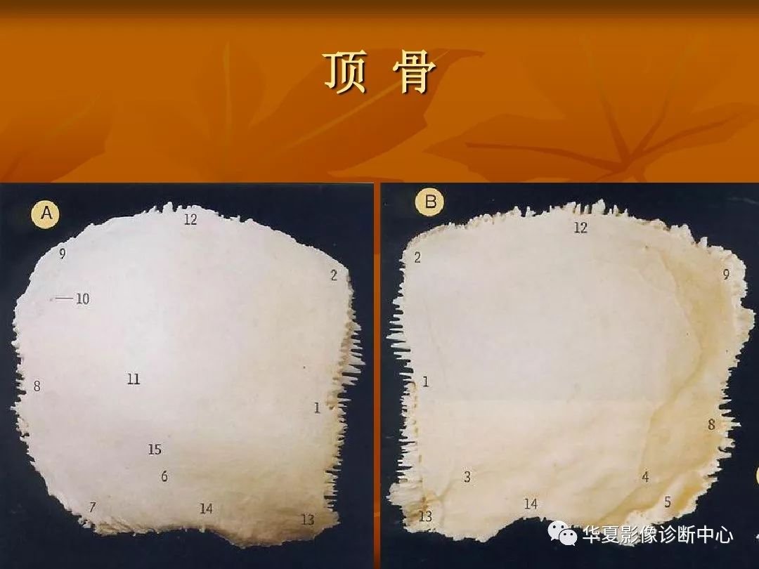 影像PPT - 【PPT】颅骨外伤性骨折CT诊断-22
