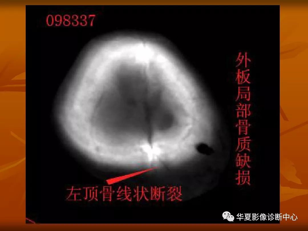 影像PPT - 【PPT】颅骨外伤性骨折CT诊断-23