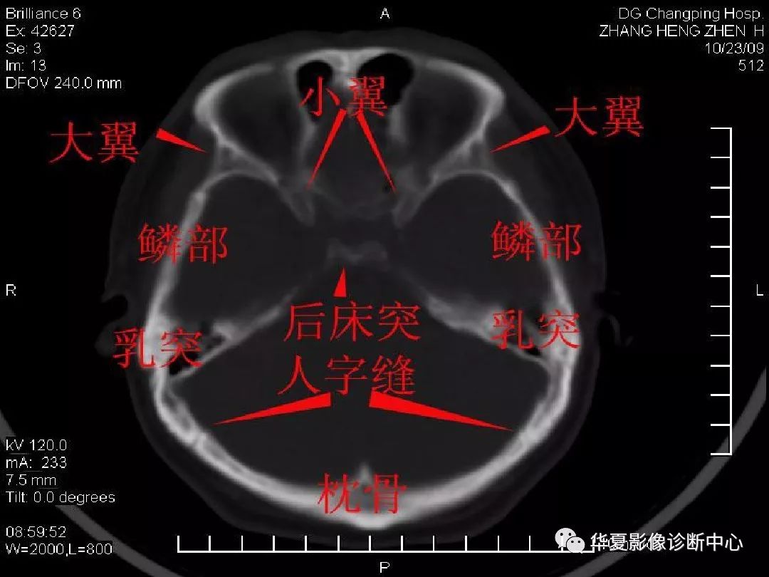 影像PPT - 【PPT】颅骨外伤性骨折CT诊断-19