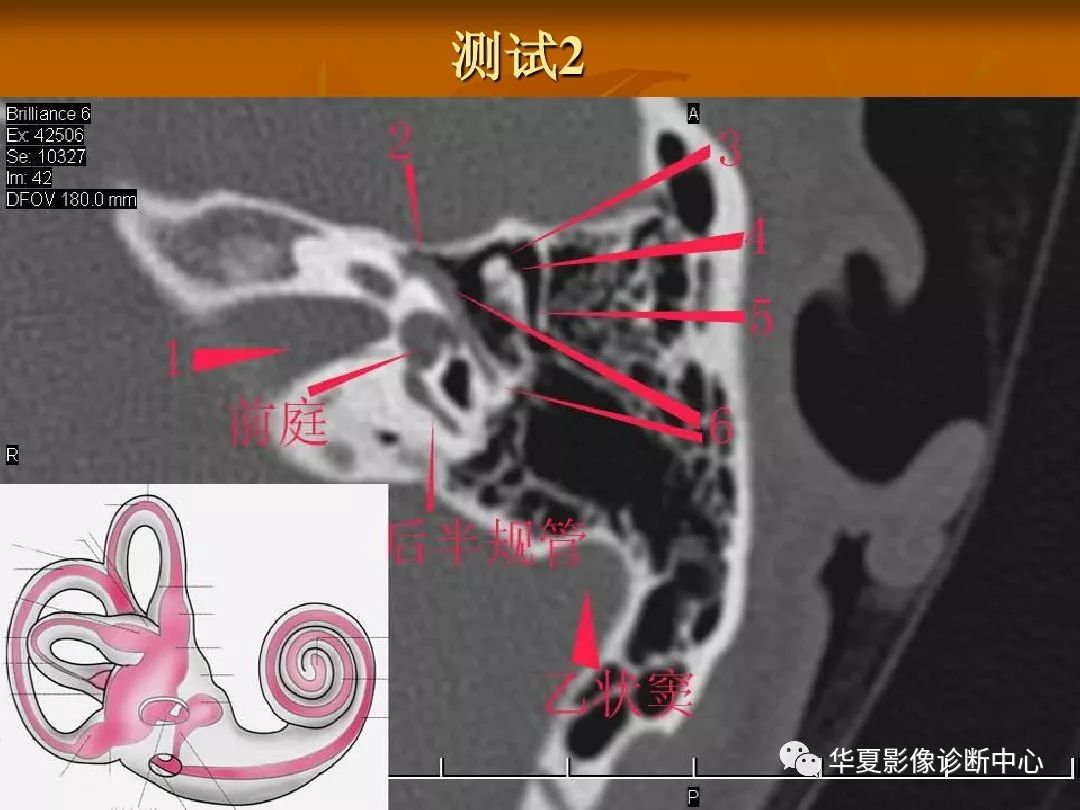 影像PPT - 【PPT】颅骨外伤性骨折CT诊断-3