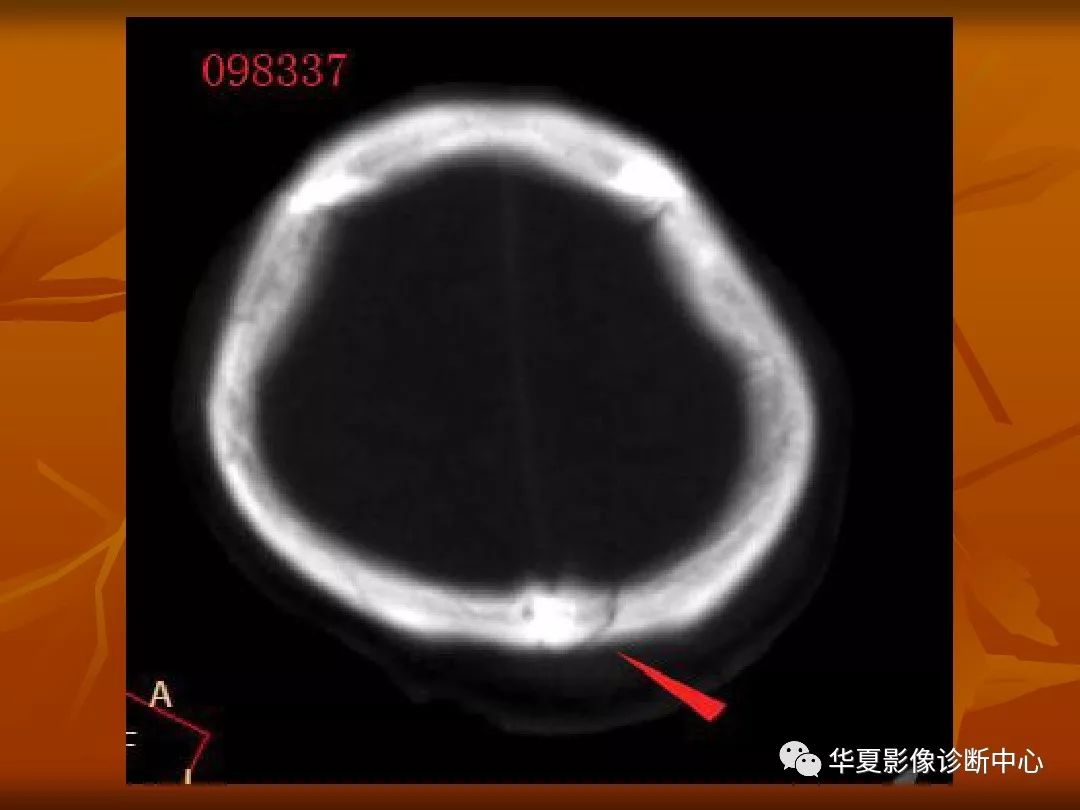 影像PPT - 【PPT】颅骨外伤性骨折CT诊断-25