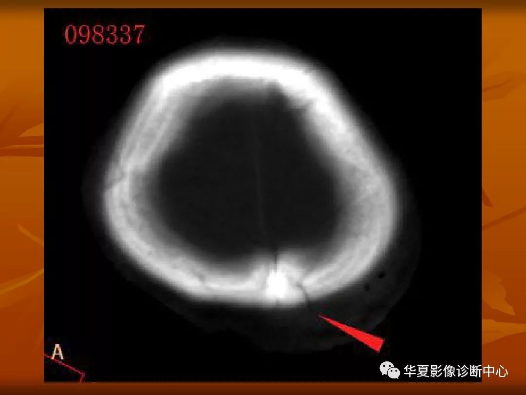 影像PPT - 【PPT】颅骨外伤性骨折CT诊断-24