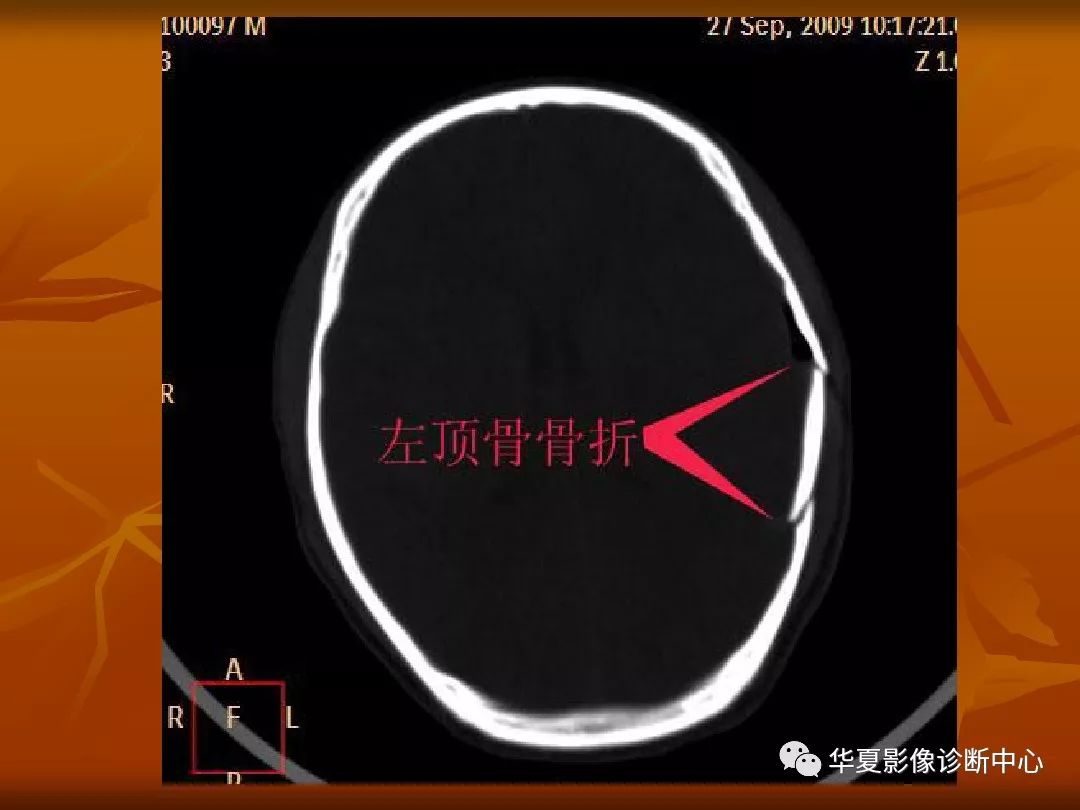 影像PPT - 【PPT】颅骨外伤性骨折CT诊断-30