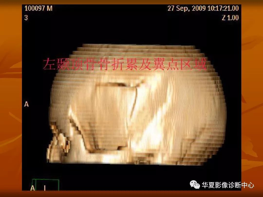 影像PPT - 【PPT】颅骨外伤性骨折CT诊断-31